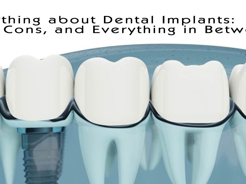 Dental implants: pros, cons, and everything you need to know